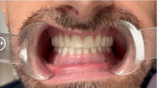 After mini dental implants