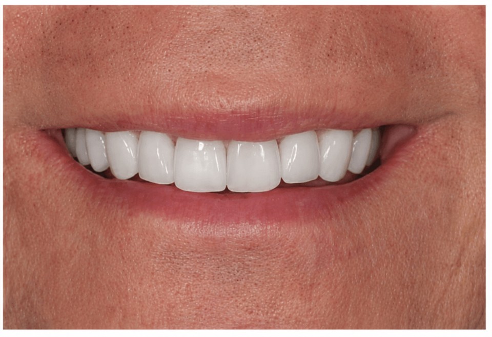 After mini dental implants