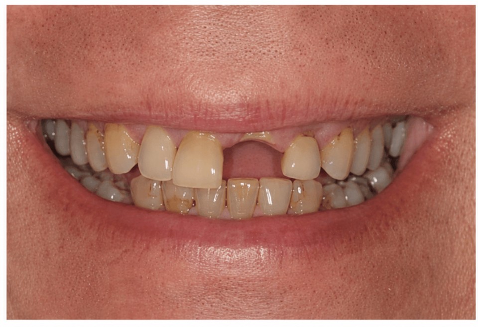 Before mini dental implants