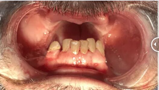 Before mini dental implants
